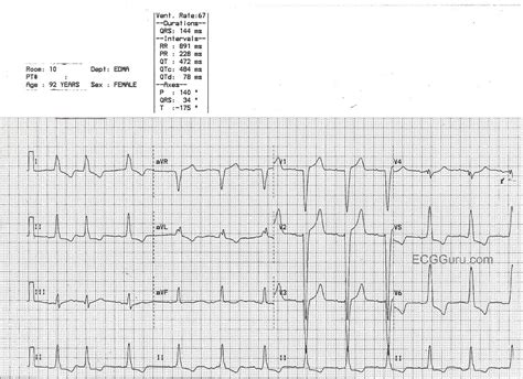 severe lvh left bundle